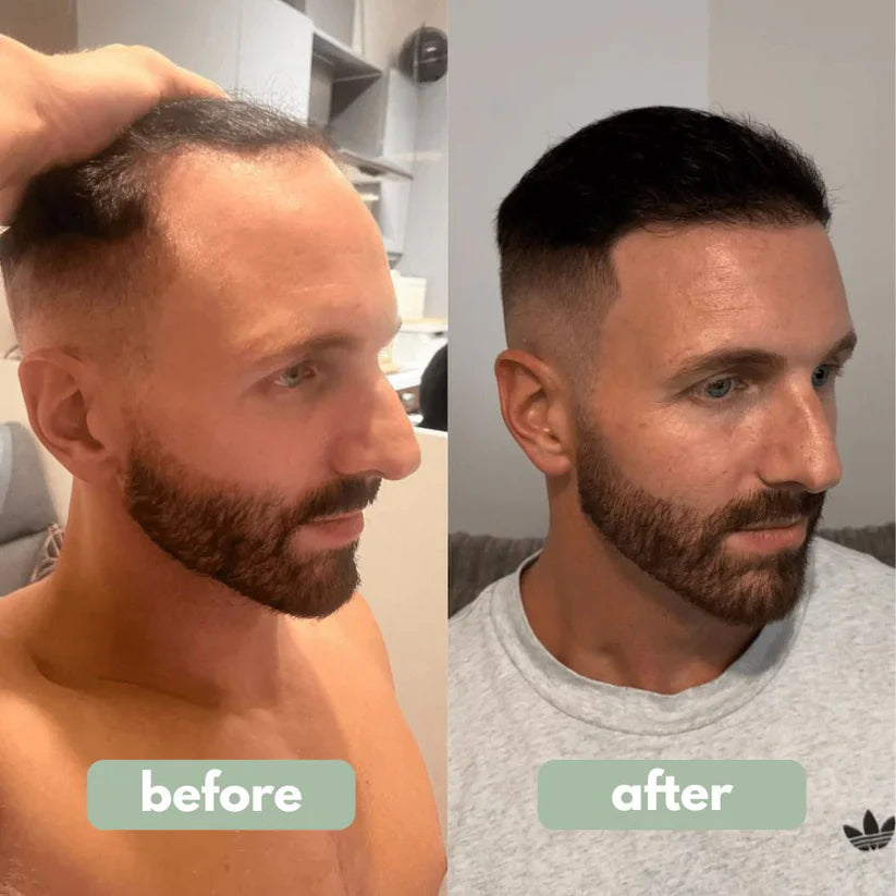 Reverse – Haargroeiserum