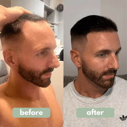 Reverse – Haargroeiserum